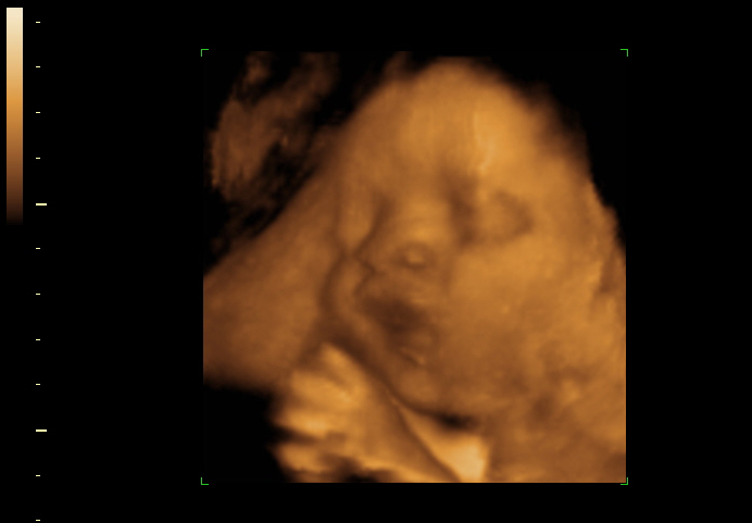 3D ultrasound image at 30 weeks
